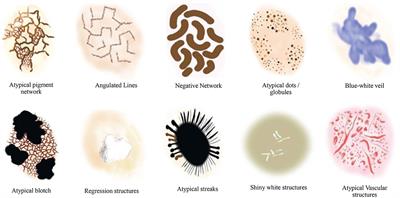 Exploring dermoscopic structures for melanoma lesions' classification